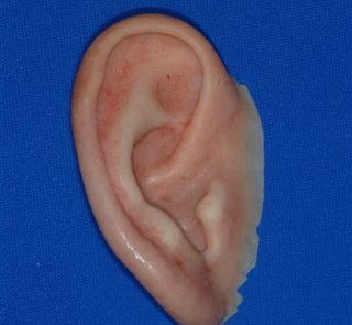 Ear Prosthesis