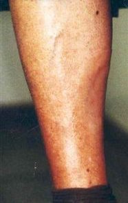 Partial Leg Prosthesis Post